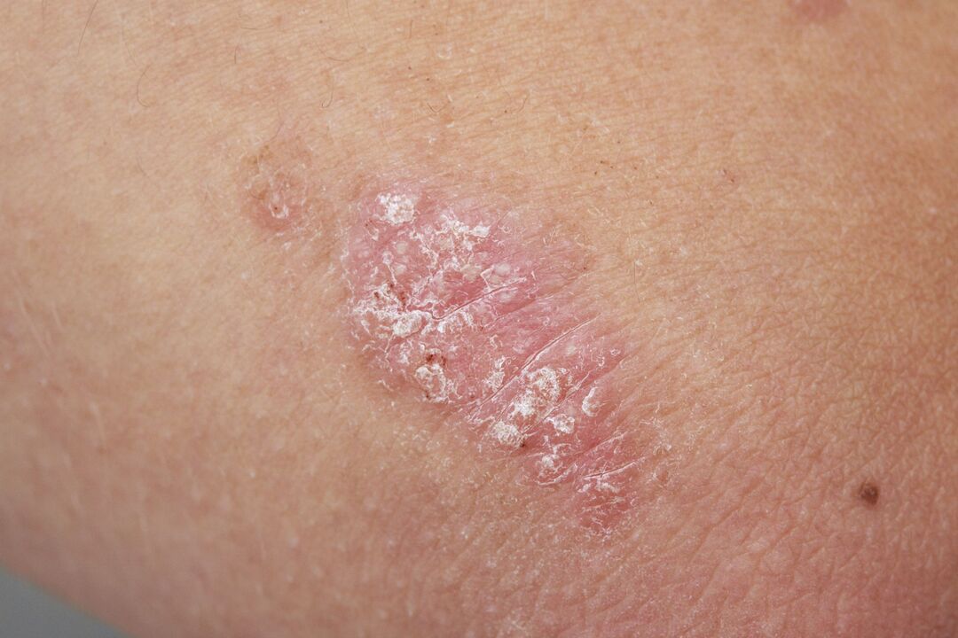 psoriasis on the skin of children