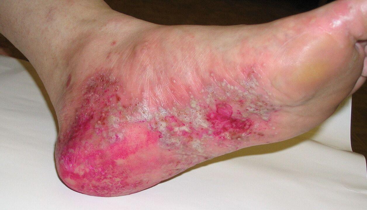 psoriasis of the feet