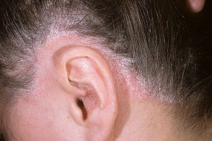 Outbreaks of psoriasis on the head behind the ears