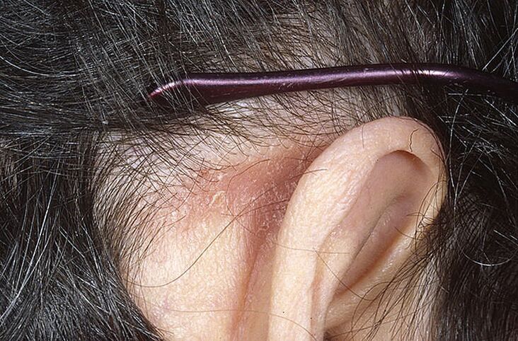 Psoriatic behind the ears