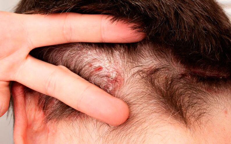symptoms of psoriasis in the head