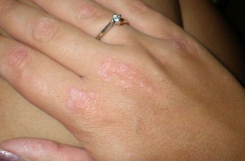 psoriasis on the hands