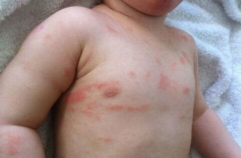 symptoms of psoriasis in children