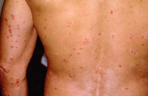 what does psoriasis look like