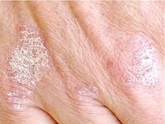 psoriasis of the skin