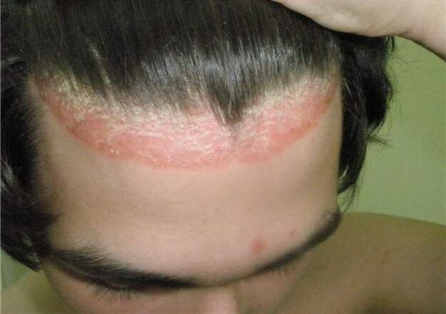crown of psoriasis on the head