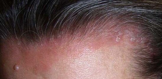 manifestations of psoriasis in the head