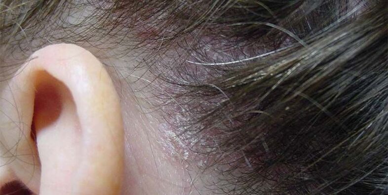 progressive stage of psoriasis in the head