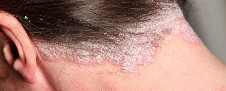 stationary stage of psoriasis