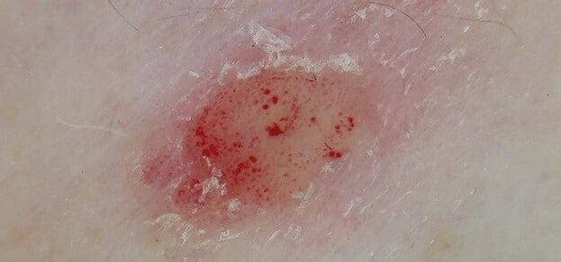 the main signs of psoriasis