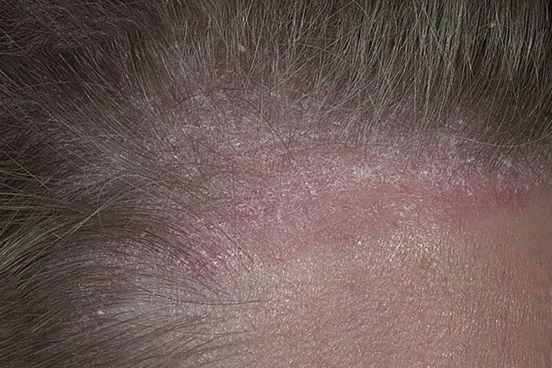 what does scalp psoriasis look like