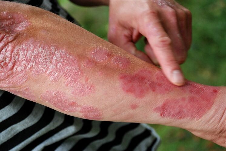 psoriatic plaques on the arms