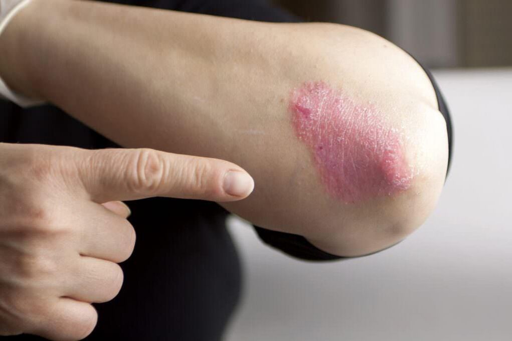 Early manifestations of elbow psoriasis