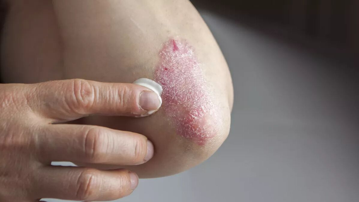 Psoriatic plaques on elbows are treated with medicated creams
