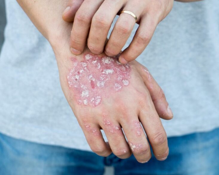 Psoriasis in hand