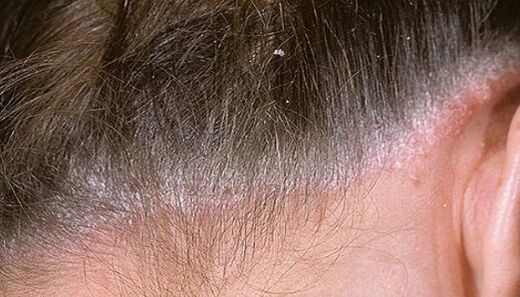 Psoriasis in the head