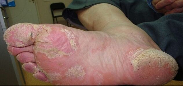 Psoriasis on the feet