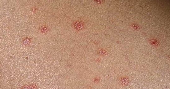 Psoriatic plaque
