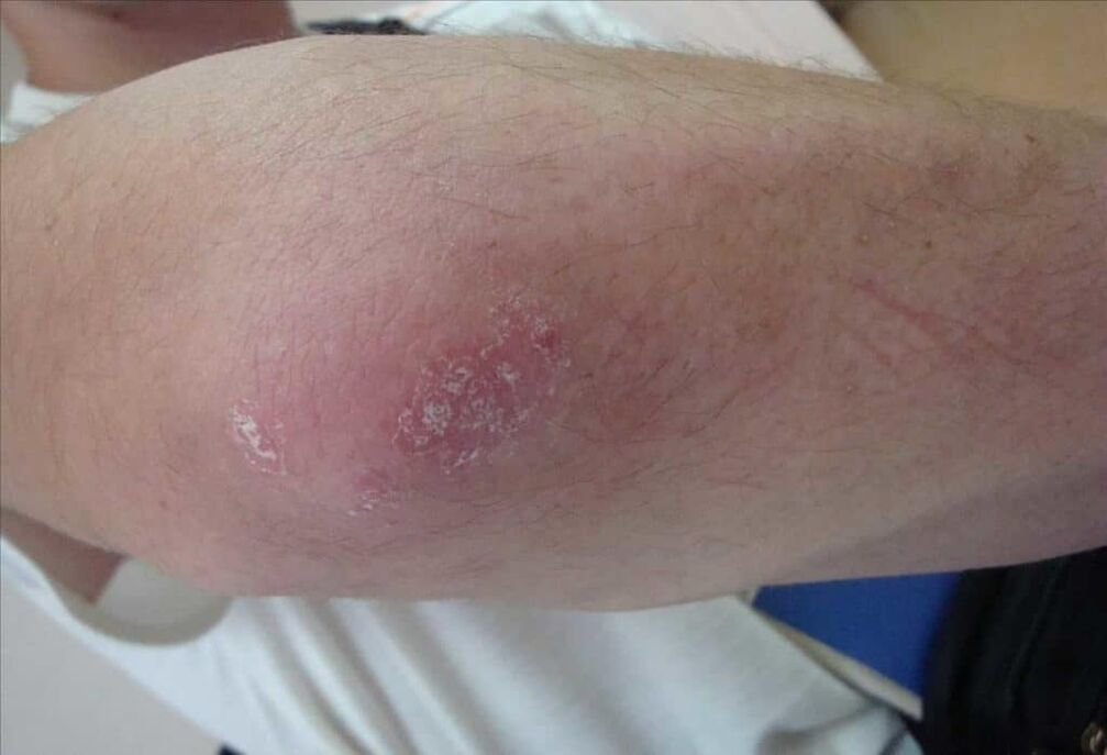 Like what psoriasis
