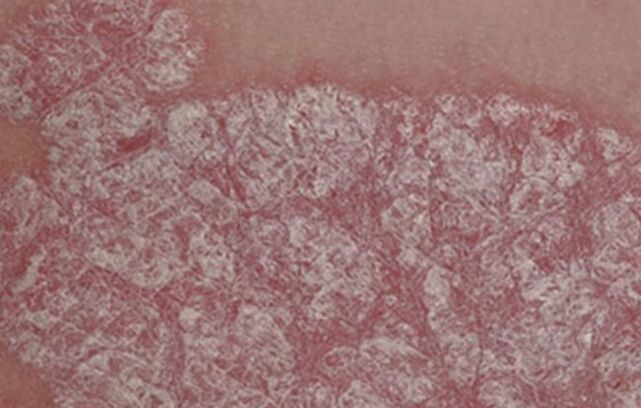 Cure of papules