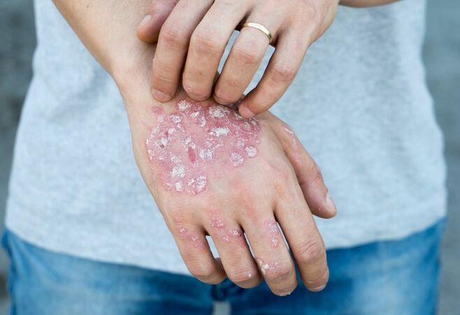 Psoriasis mesnichered