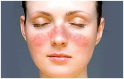 Psoriasis in the face