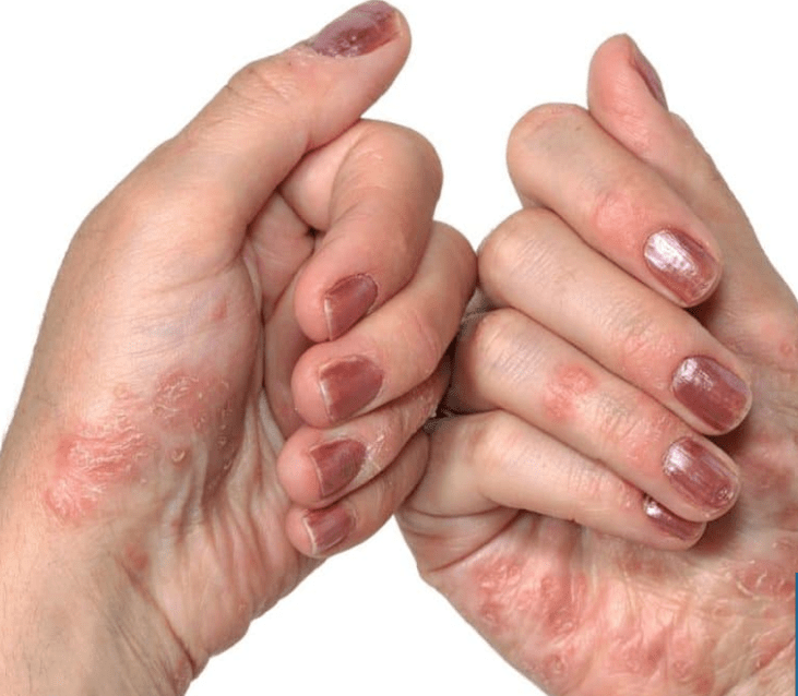Psoriasis in hand