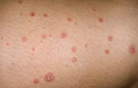 Psoriatic plaque