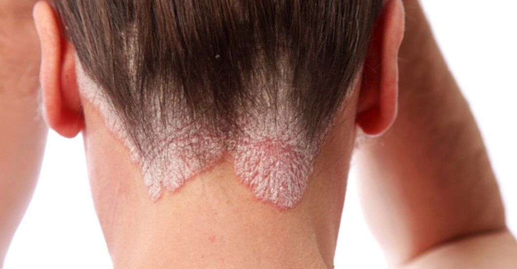 Psoriasis in the head of the girl