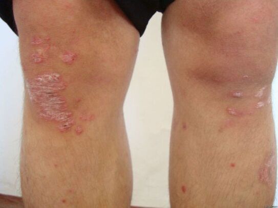 The cause of psoriasis