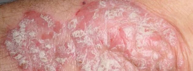 Psoriasis mesnichered