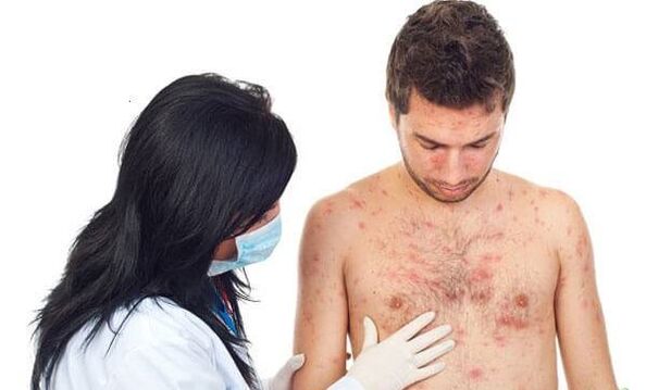 Photos of psoriasis