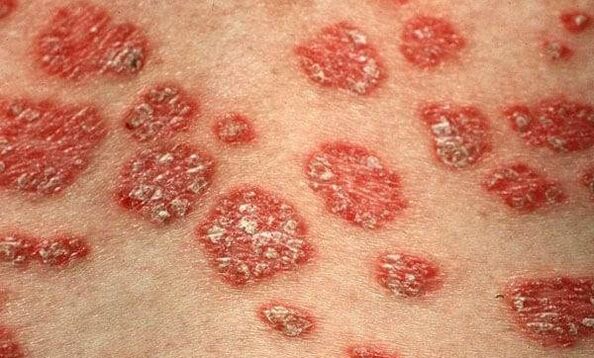 The form of psoriasis