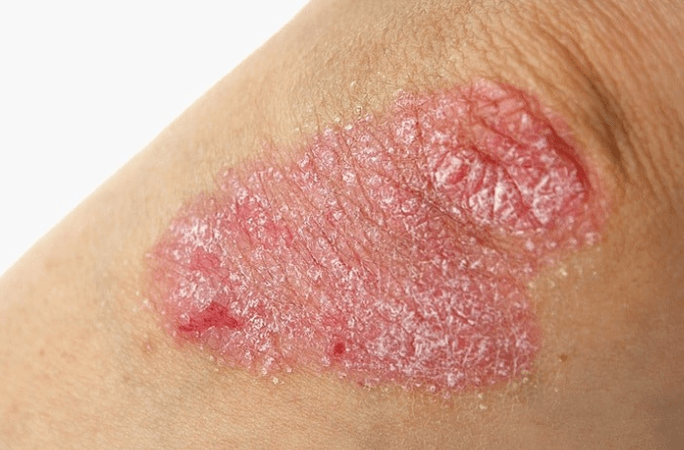 Stages of progressive psoriasis