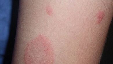 How does the initial stage of psoriasis manifest itself