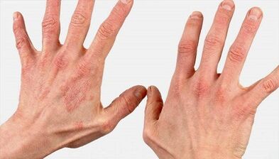 What does early stage psoriasis look like