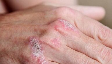 early symptoms of psoriasis