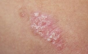 cause of psoriasis