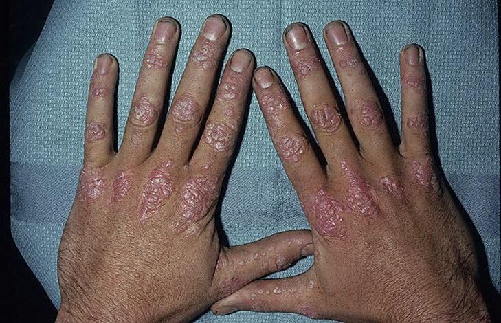 causes of the development of psoriasis in the hands