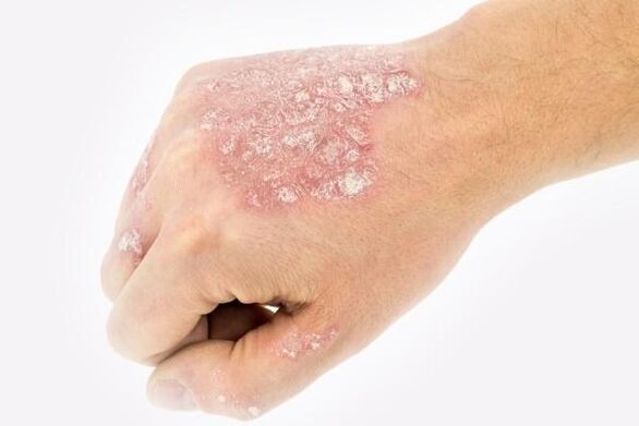 mechanism of development of psoriasis in the hands