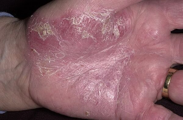 psoriasis on the palms of the hands