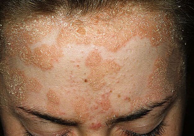 seborrheic psoriasis of the forehead