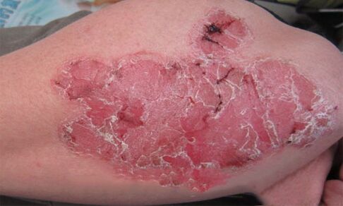 what is the pustular form of psoriasis on the skin