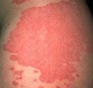 Consolidation of psoriatic plaques