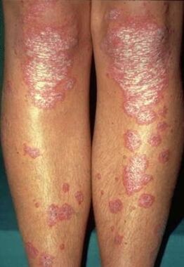 Manifestations of psoriasis on the feet