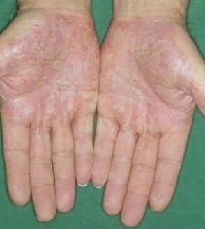 Psoriasis of the palms