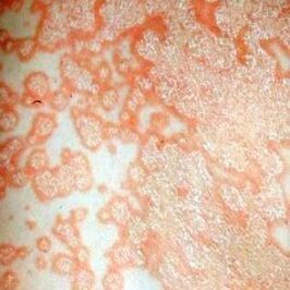 Psoriatic plaques on the body