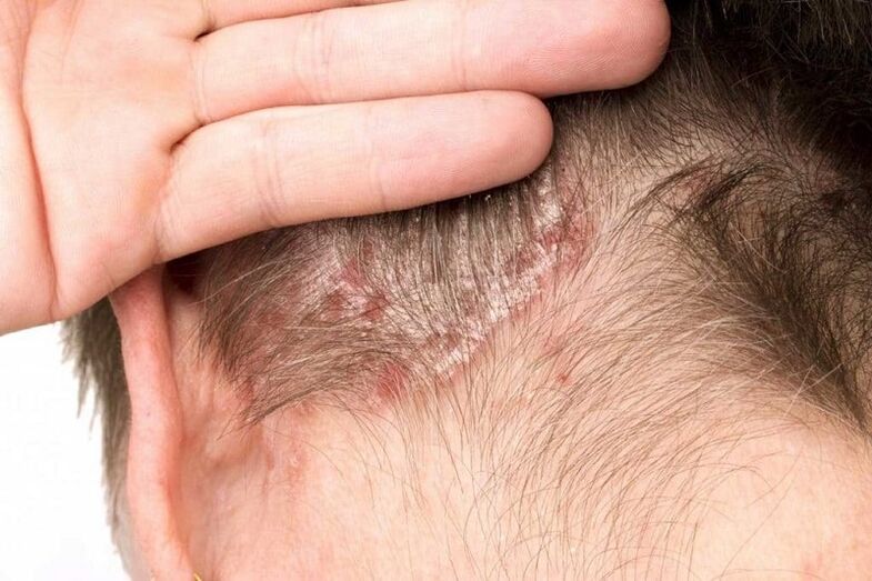 pictures of psoriasis on the head