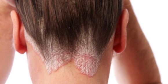 Obvious papules on the scalp