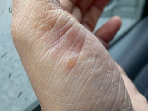 pictures of psoriasis on the hands